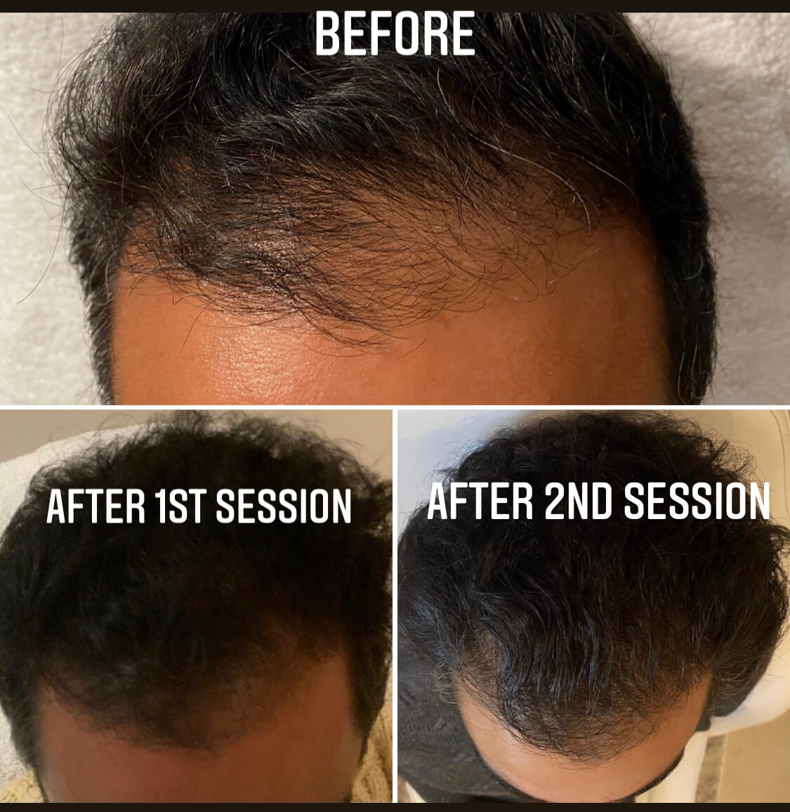 What Is Platelet-Rich Plasma Therapy (PRP) for Hair Loss?