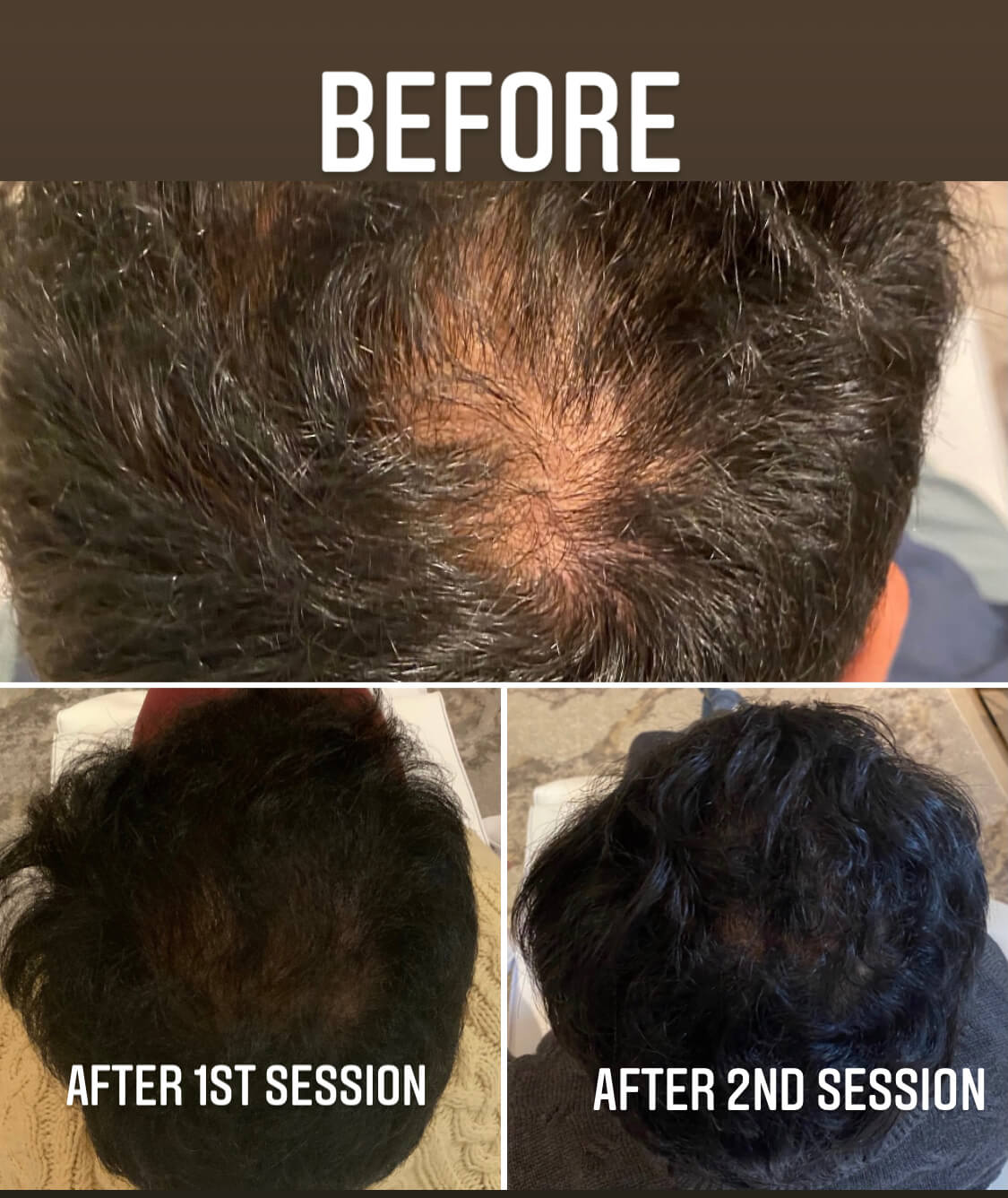 Prp Treatments Needed For Hair | Beverly Hills Hair Restoration