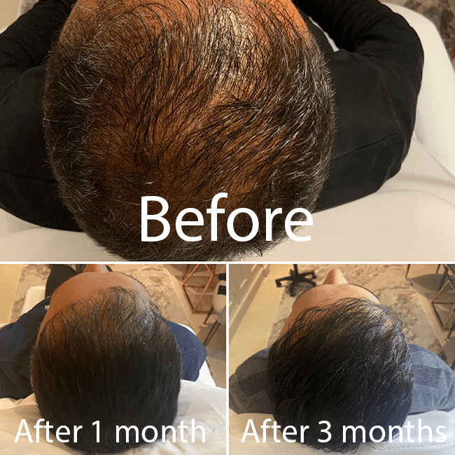 PRP for Hair Growth in Cobham, Surrey - Face & Fillers