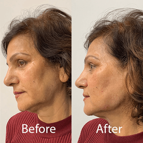 Jaw Fillers before and after